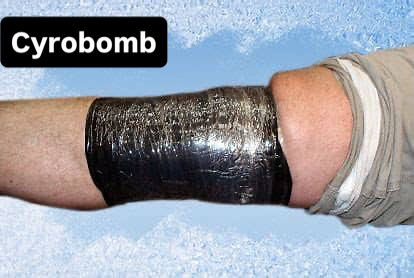 Occlusion Strapping is a way to drive CRYODERM®